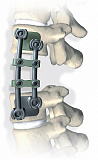 Пластина (скоба) XIA anterior, с двумя отверстиями, каудальная, средняя